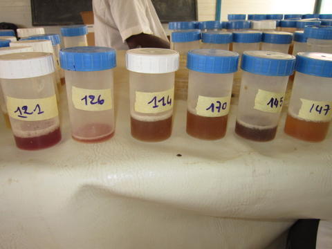 Schistosomiasis hematuria